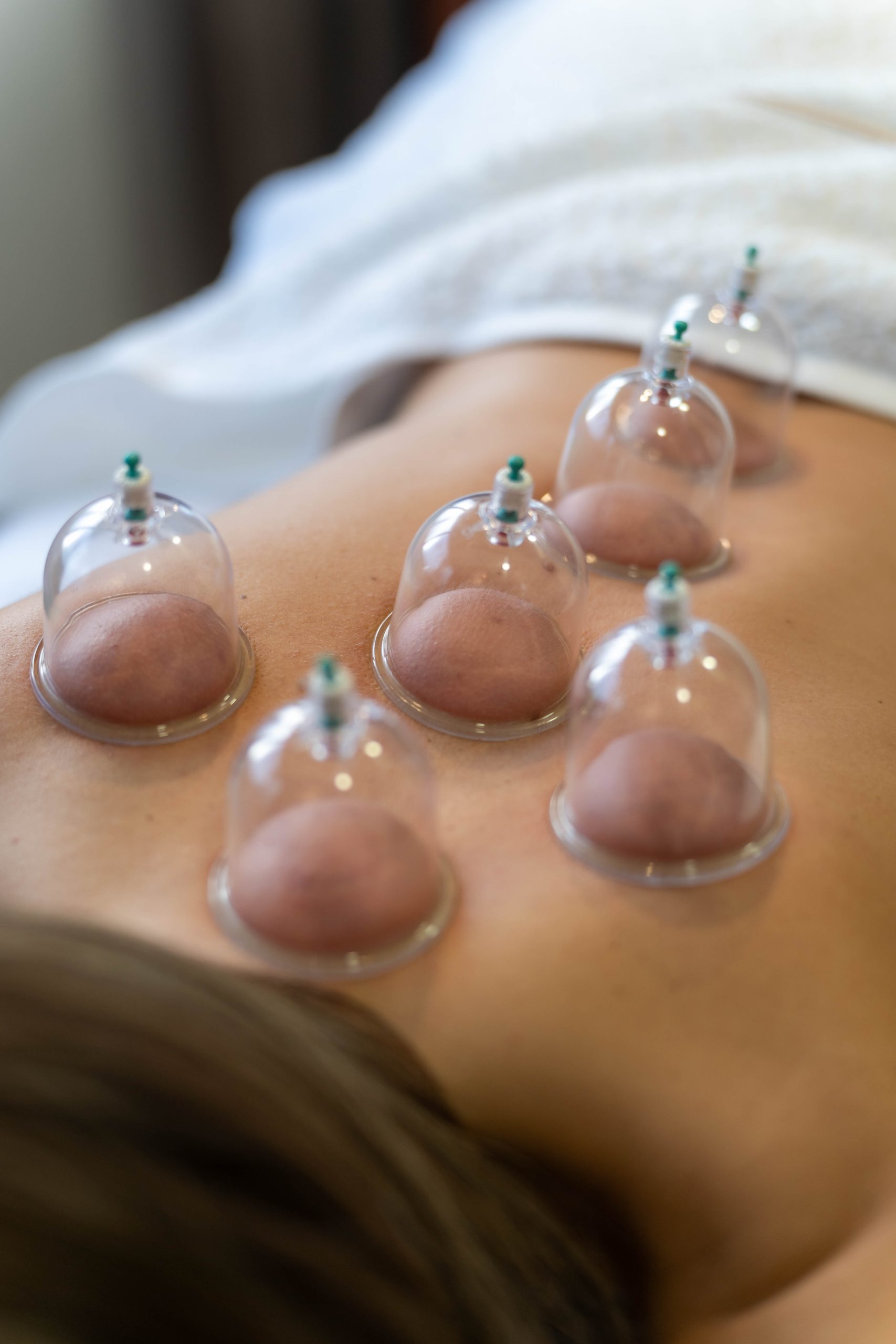 CUPPING