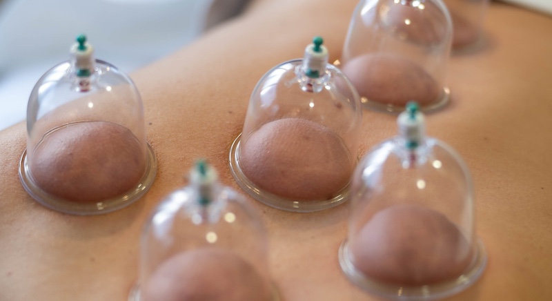 Cupping terapija: dobrobiti, značenje tragova i sigurna primjena Tradicionalne Kineske Metode